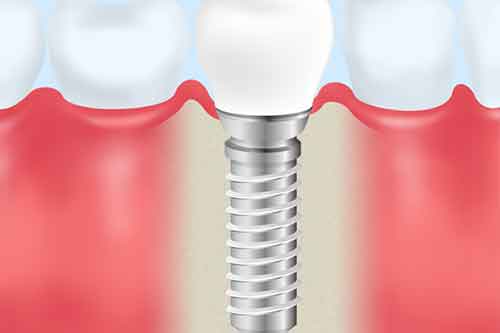 インプラント治療