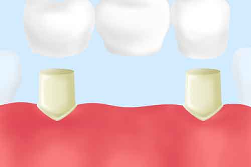 ブリッジ治療