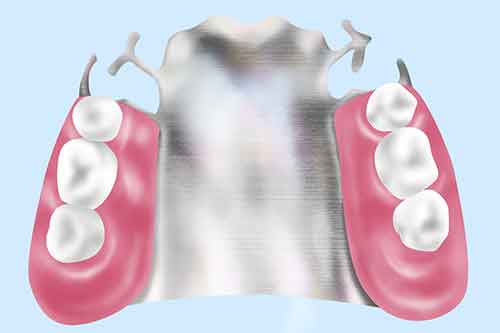 コバルトクロム床義歯（総入れ歯・部分入れ歯）
