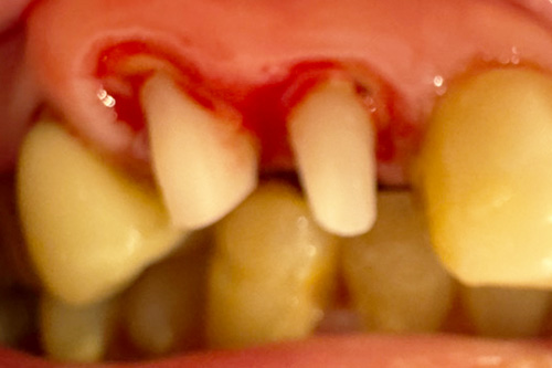 ファイバーコア（保険適応）