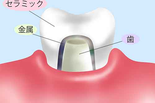 オールセラミック（e-max）
