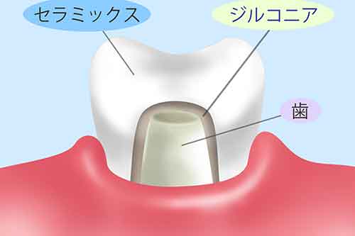 ジルコニアセラミック