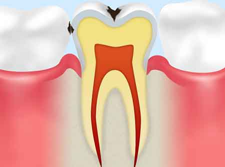 エナメル質の虫歯