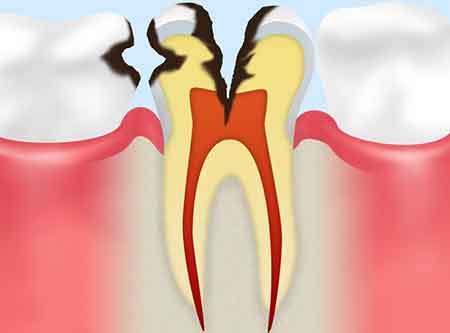 歯の神経に達した虫歯