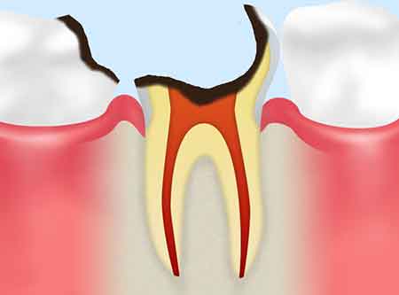 歯根に達した虫歯