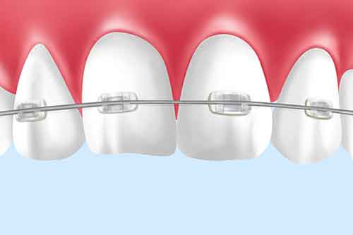 マルチブラケット装置（普通矯正）